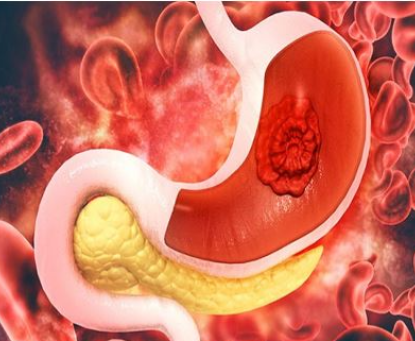 Tổng quan về bệnh xuất huyết tiêu hóa